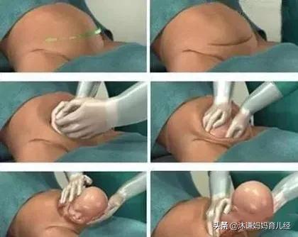 剖腹产后如何尽快恢复元气(二胎剖腹产后元气恢复)