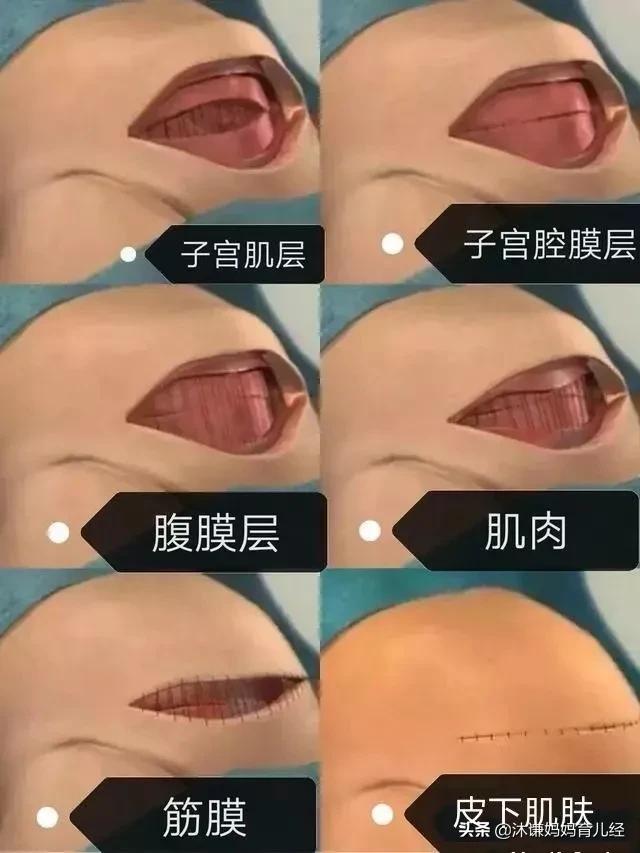 剖腹产后如何尽快恢复元气(二胎剖腹产后元气恢复)