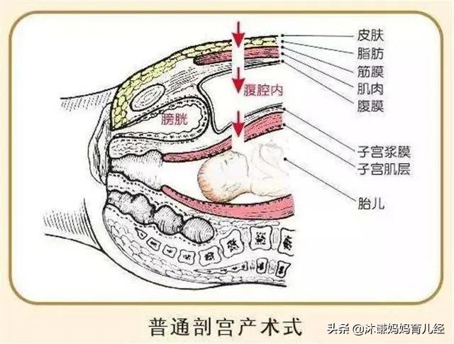 剖腹产后如何尽快恢复元气(二胎剖腹产后元气恢复)