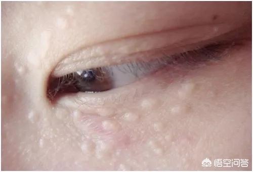 养生堂眼部精华霜脂肪粒用什么护肤品可以祛除